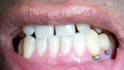 Caria radiculara, tratament stomatologic clinica JoliDent