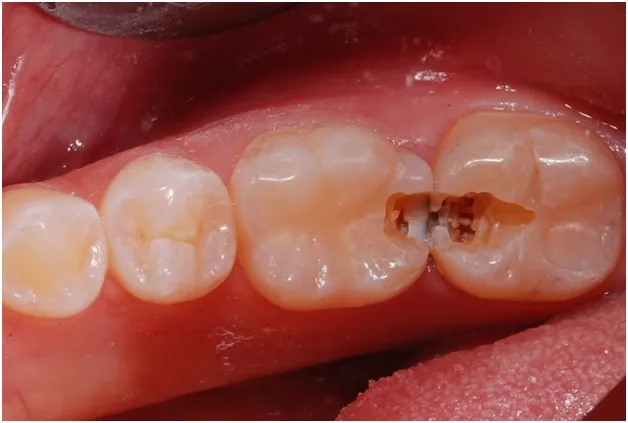Carie interdentara JoliDent Buzau