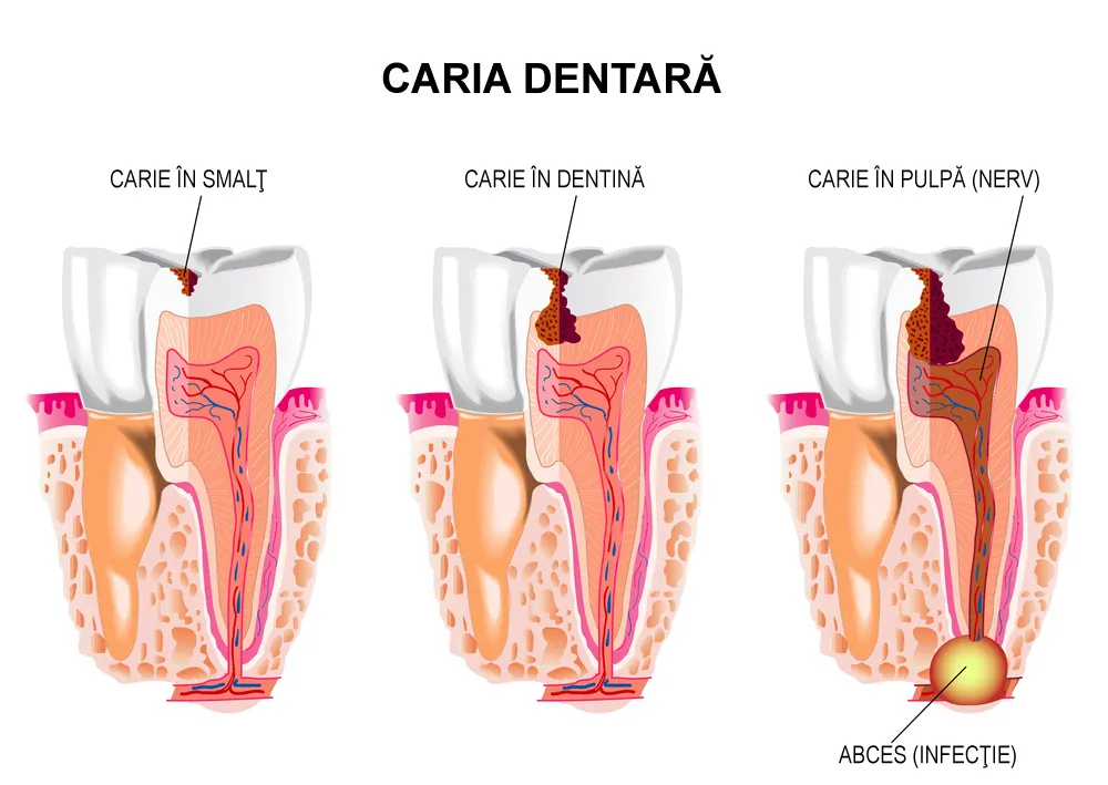 Formarea cariei dentare