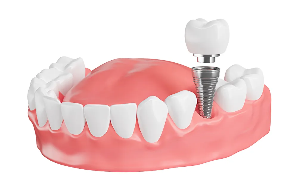 Macheta dinti cu implant dentar si coroana dentara