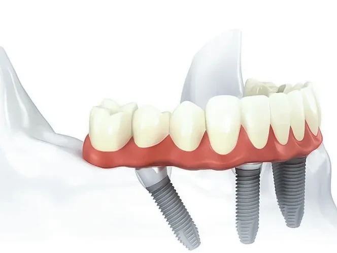 Restaurari All-on-4, implanturi dentare clinica JoliDent, stomatologie in Buzau