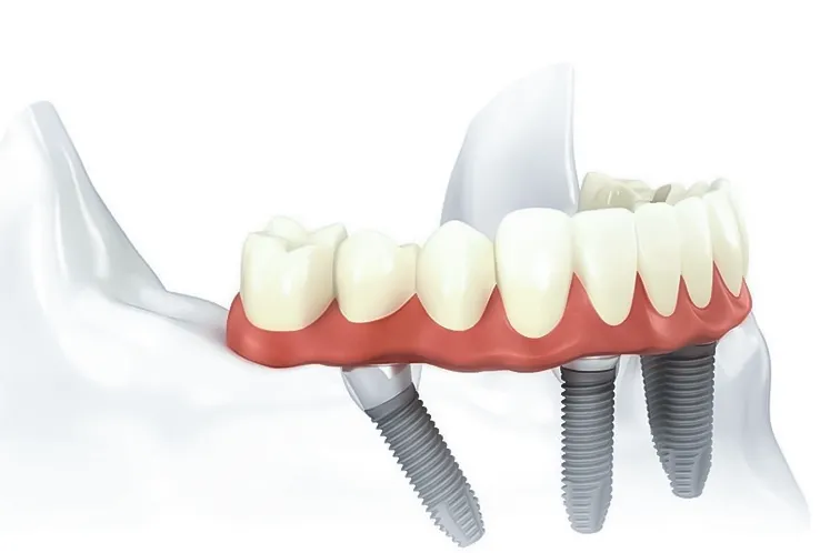 Restaurari All-on-4, implanturi dentare clinica JoliDent, stomatologie in Buzau
