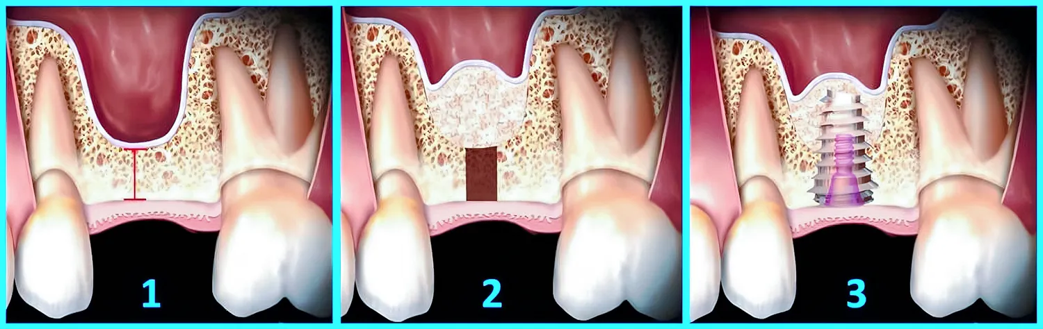 Sinus lift clinica stomatologica JoliDent Buzau