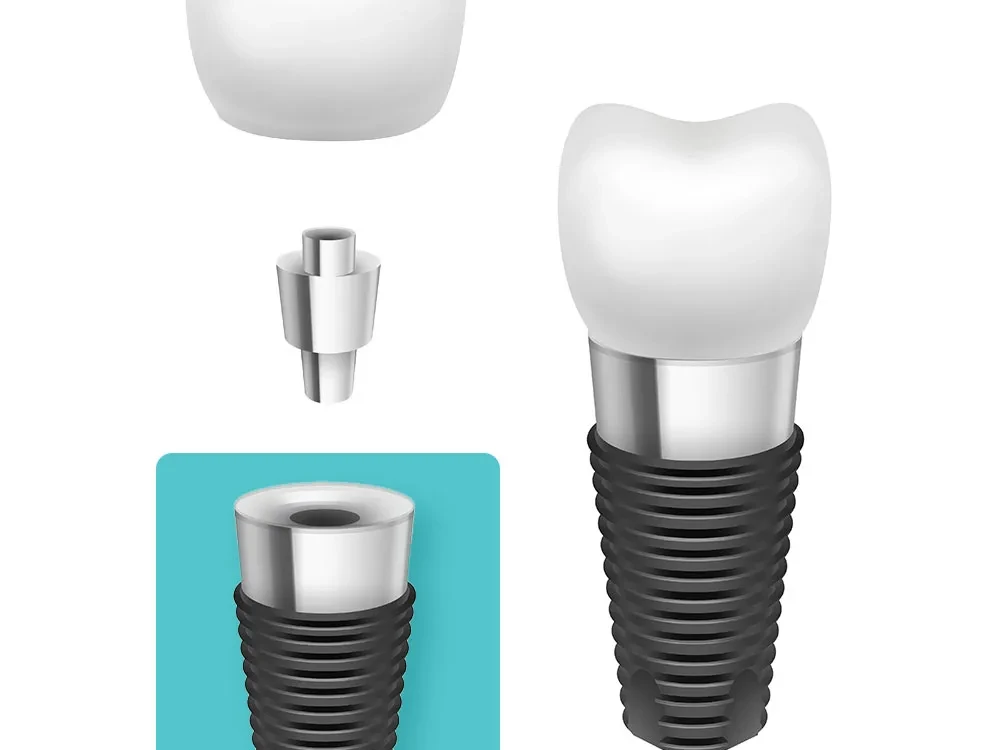 Implant dentar