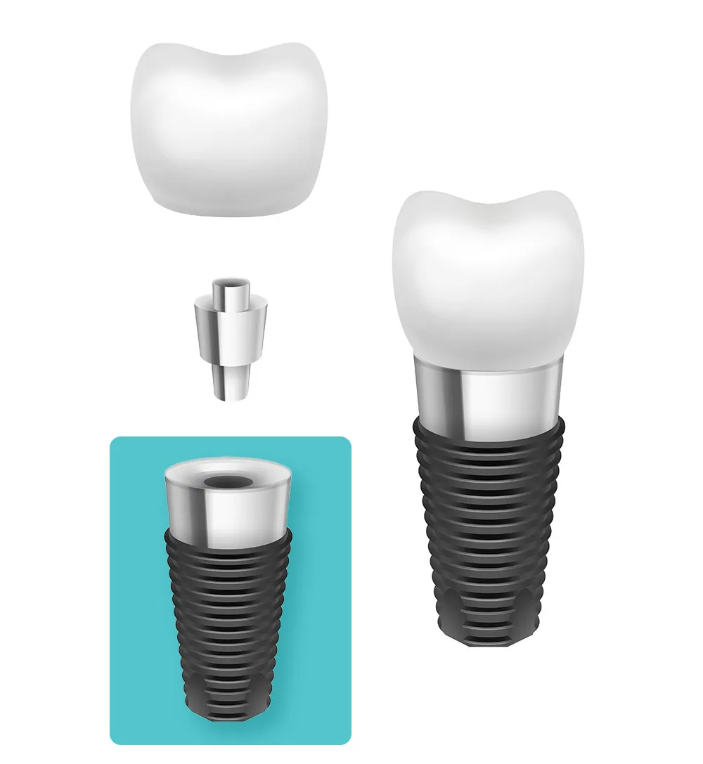 Implant dentar