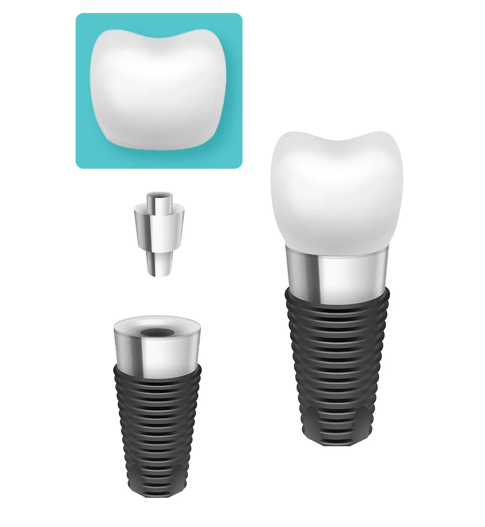 Lucrare protetica stomatologica - coroana dentara