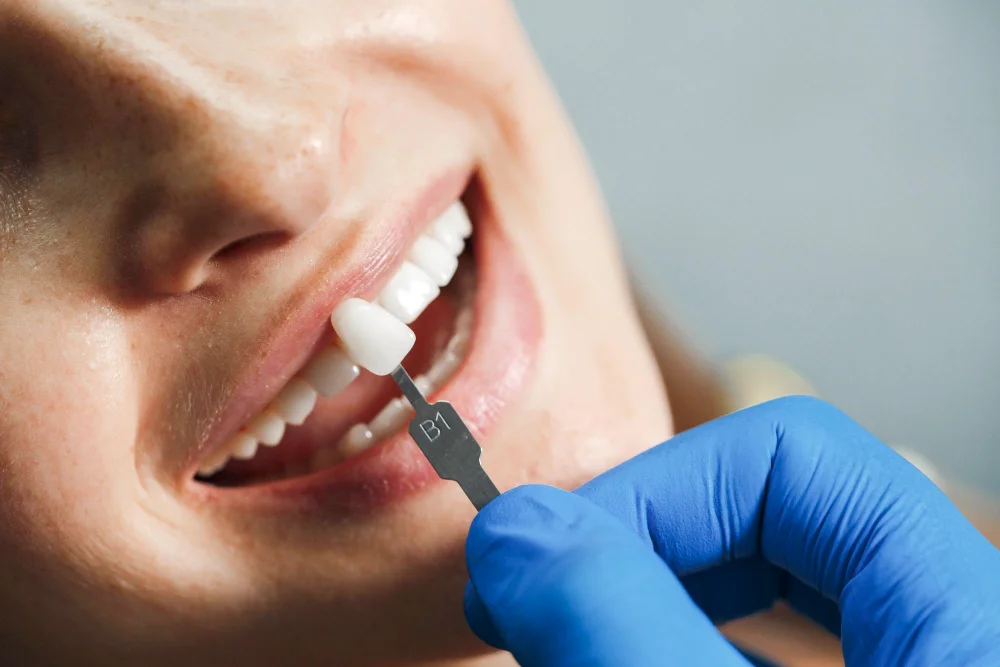 Restaurare dentara clinica Jolident: Obturatia din compozit, fatete de portelan, coroana dentara din ceramica