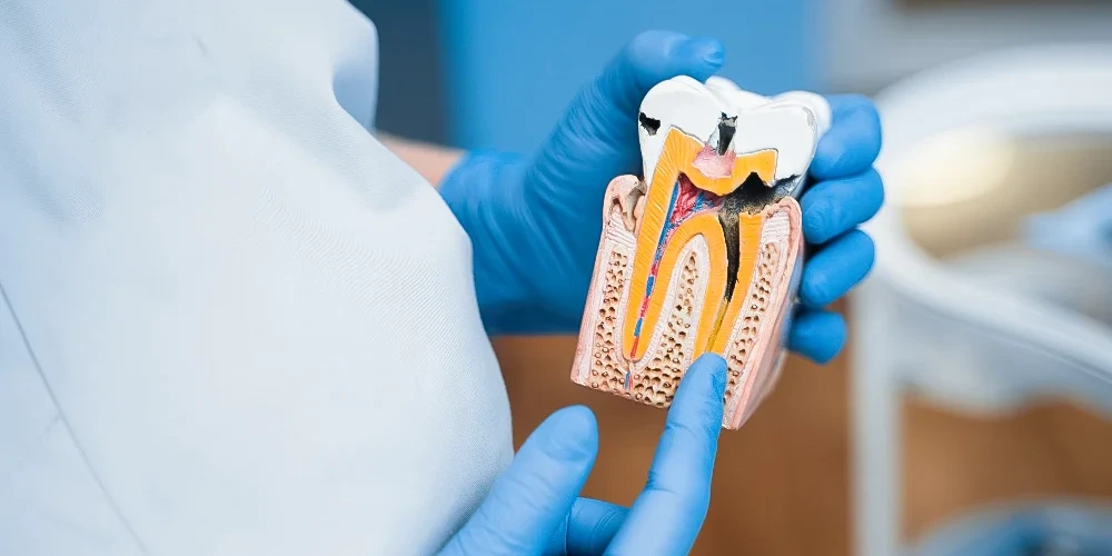 Chirurgie dentara Buzau, exemplificare tratament de canal, dinte cariat, clinica JoliDent
