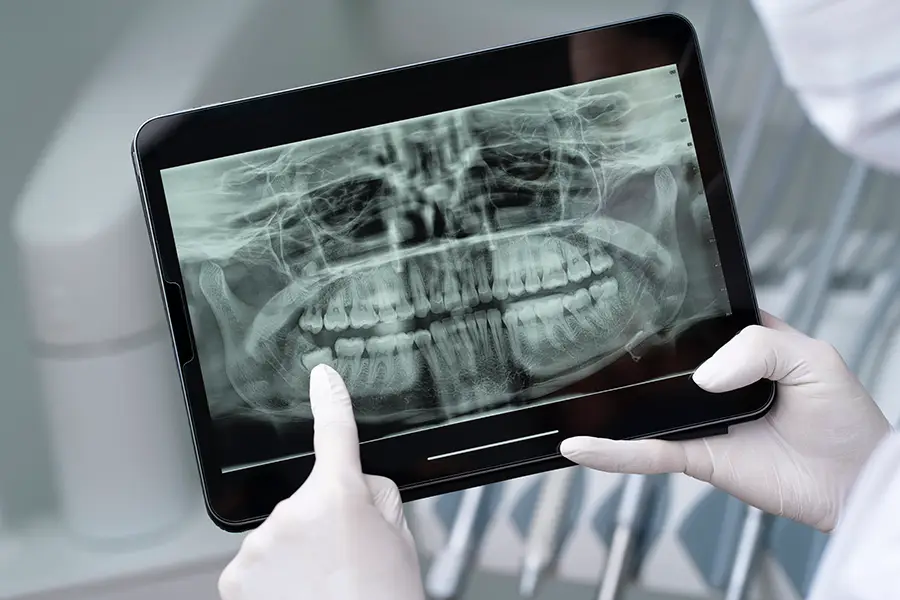 Radiografie dentara digitala