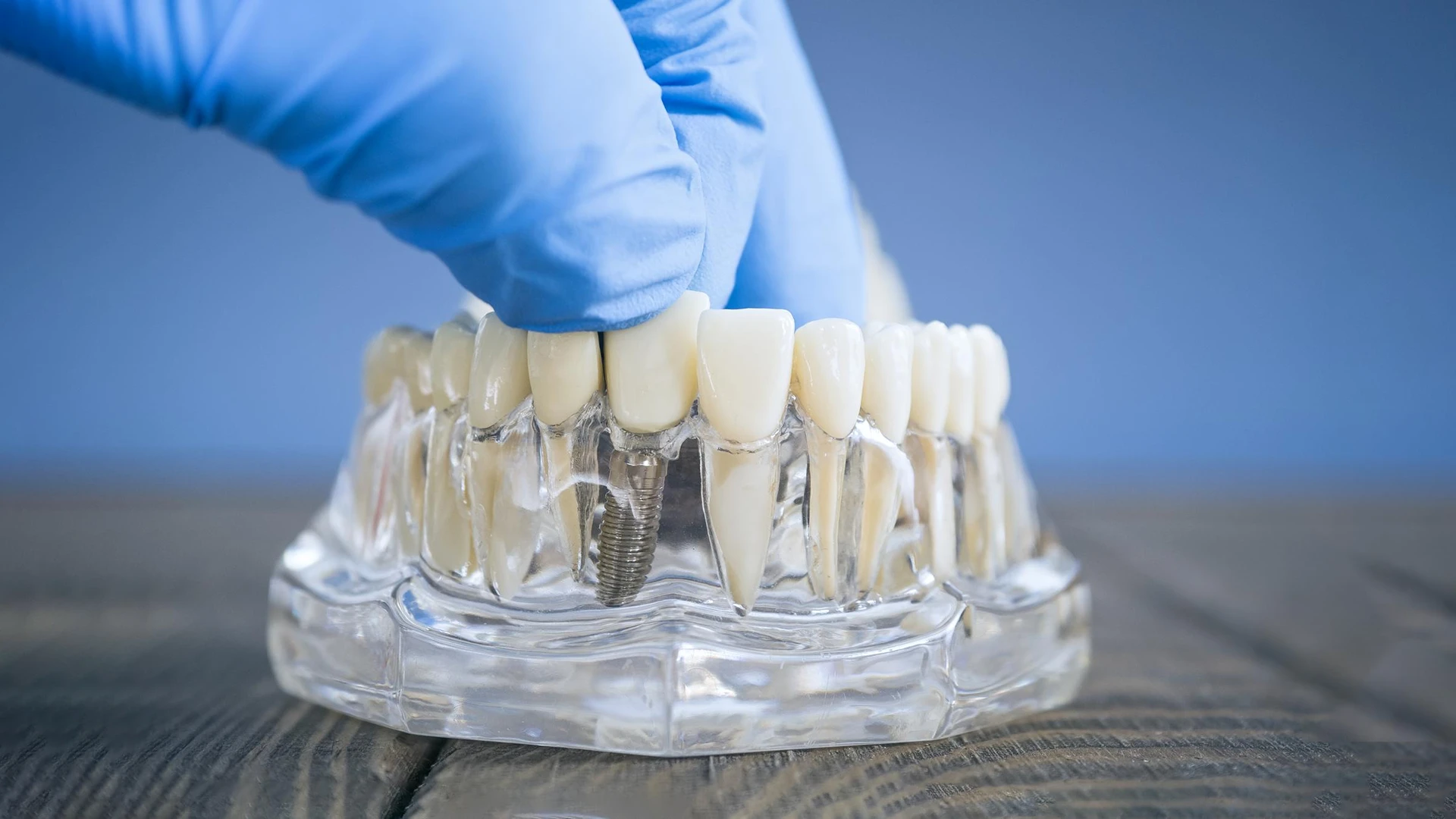 Implanturi dentare premium vs. ieftine