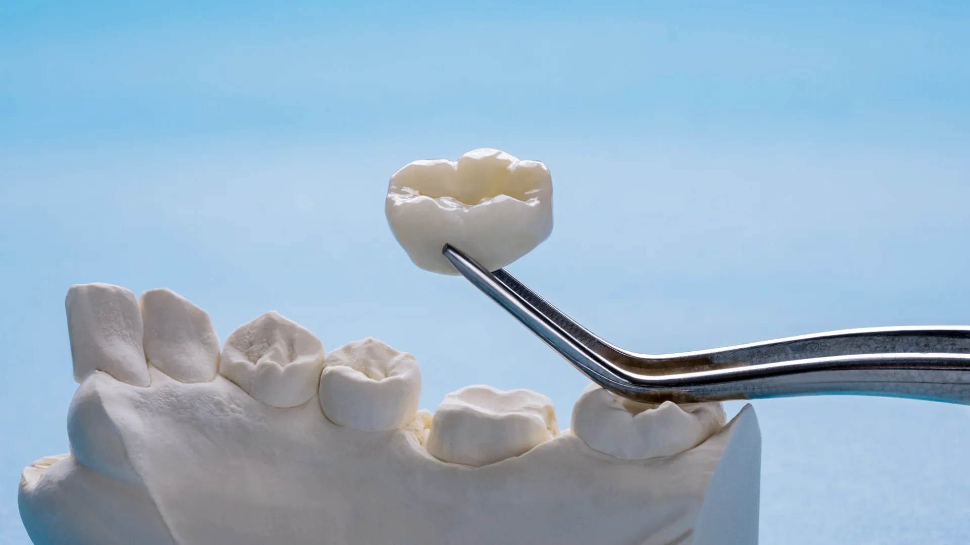 coroane dentare la JoliDent