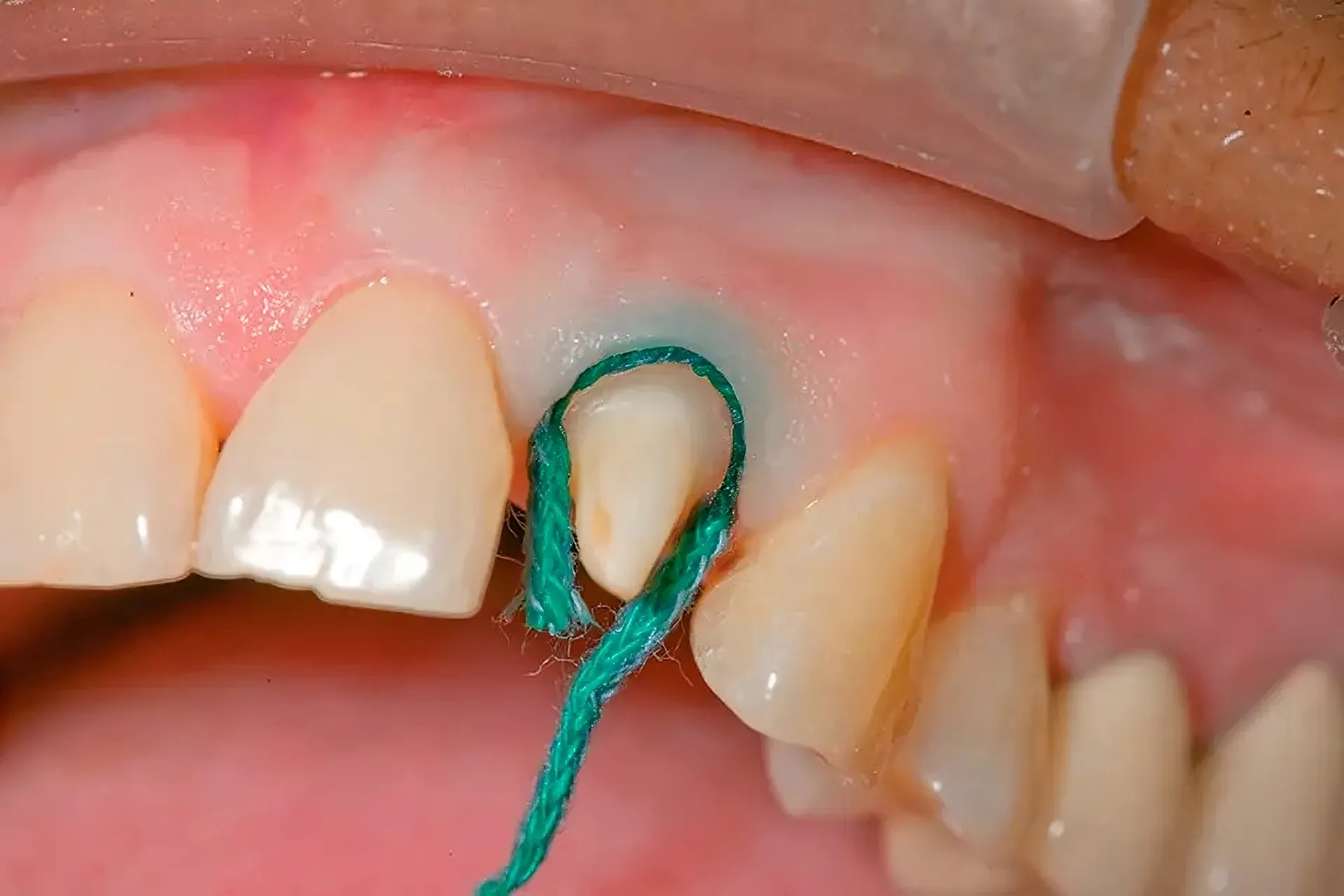 fire de retractie gingivala
